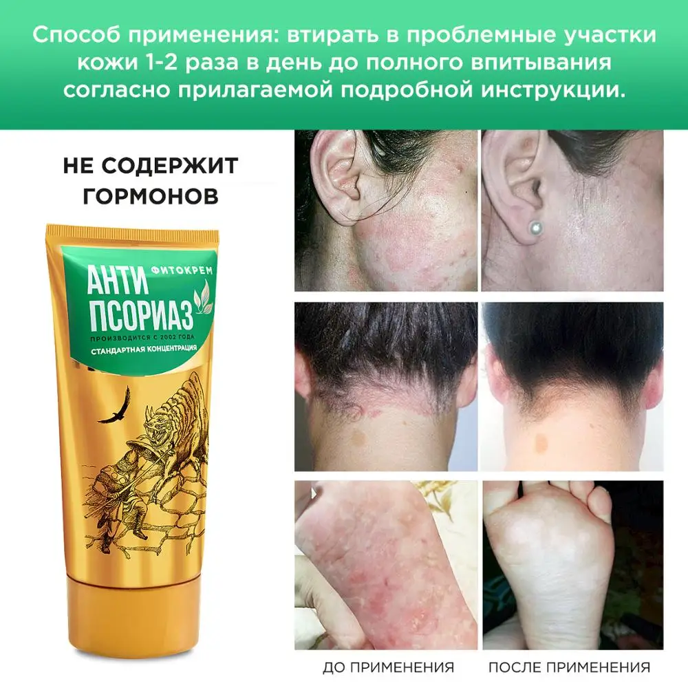 Фитокрем "Антипсориаз" Классический при псориазе |