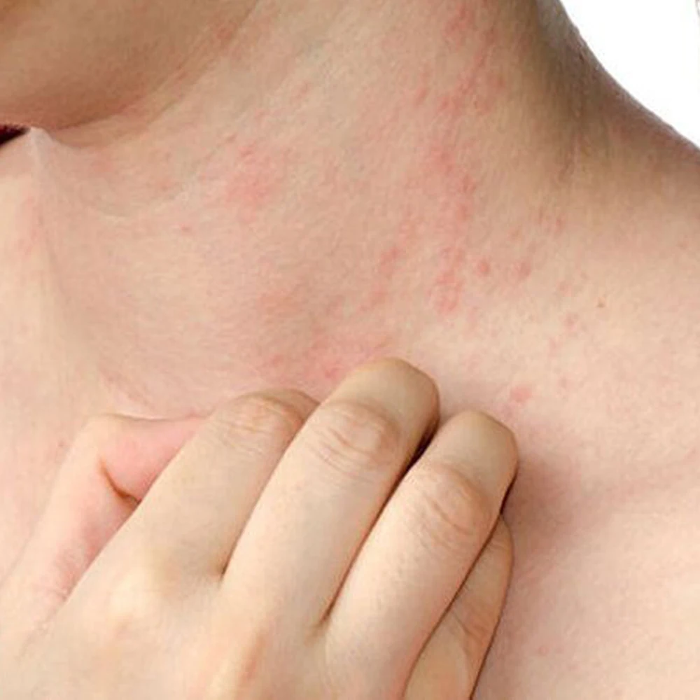 Вьетнамская мазь Dipolac G сильнейшее средство от всех кожных заболеваний|Эфирное