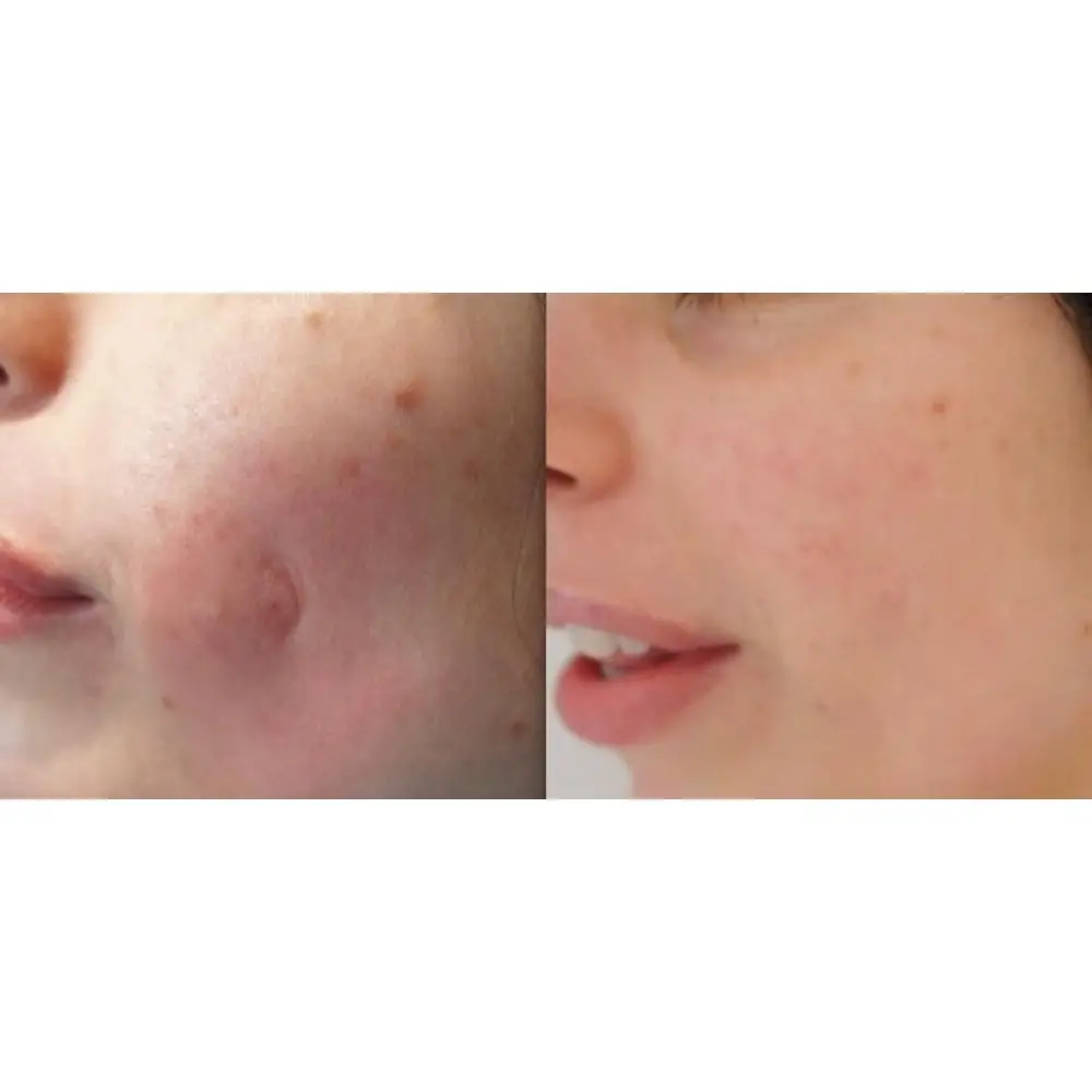 Экстракт гидрохинона для лица и кожи лечение акне мелкие морщины отбеливание