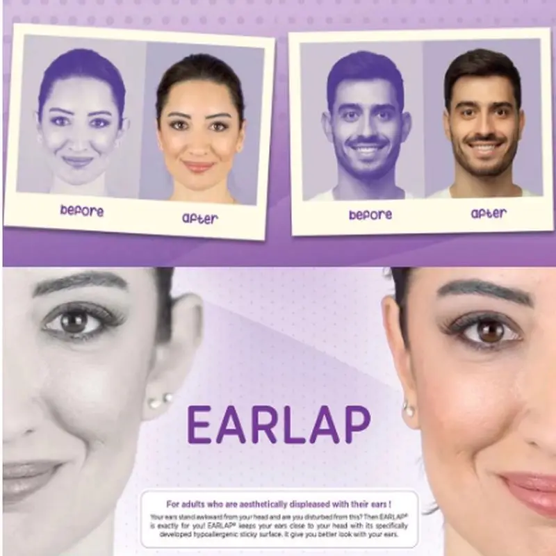 

Beauty Tapes EARLAP Ear concealer Corrector Instant effect sticking system for protruding ears, ear sticking tapes