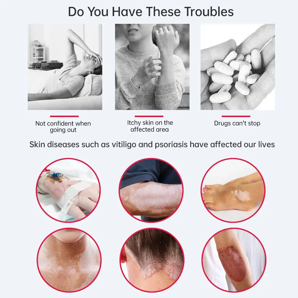 YOUWEMD УФБ фототерапевтический аппарат 311 нм узкополосная ультрафиолетовая лампа лазерного лечения против витилиго псориаза белых пятен кожи.