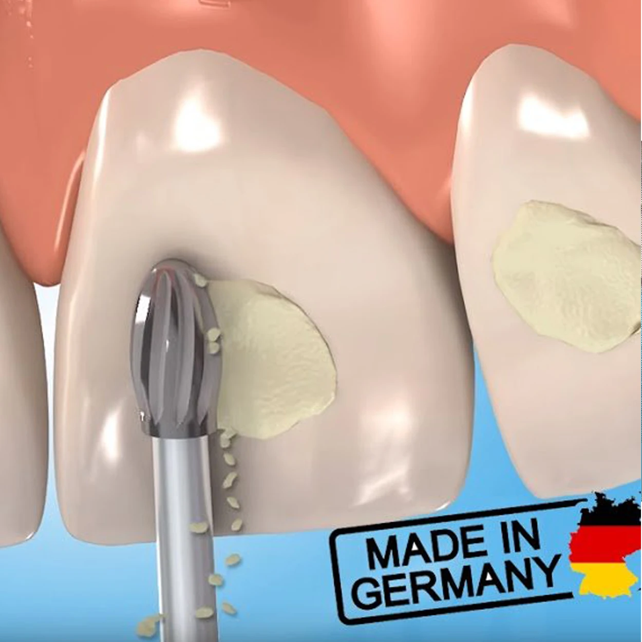 Ортодонтический прибор Frank Dental 379AGK для удаления клея боры (безопасный конец)
