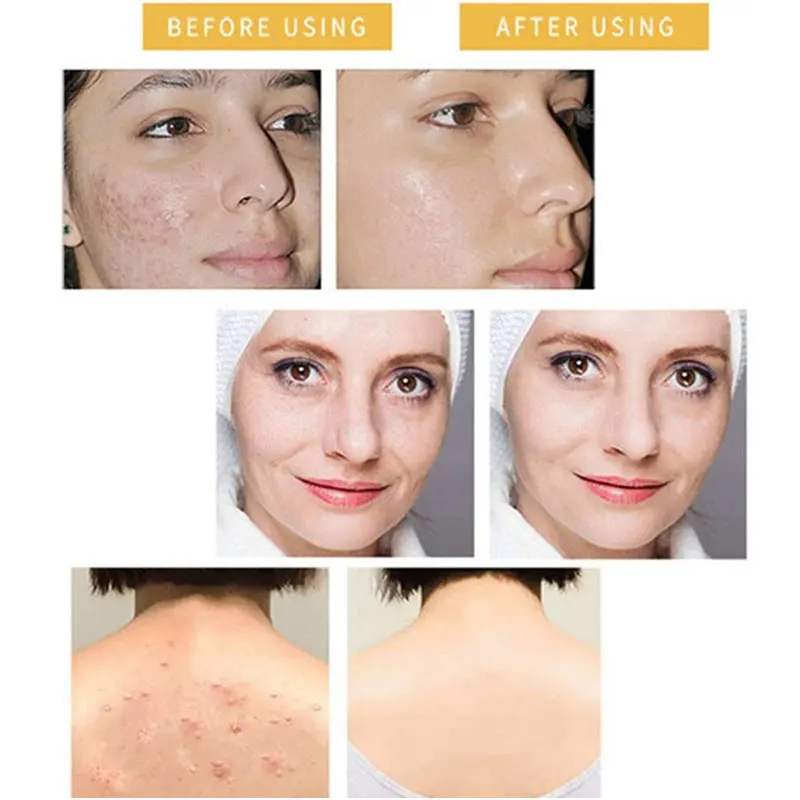 Чистый порошок 99% койевой кислоты косметический отбеливающий уход за кожей