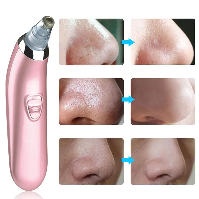 Волшебное средство для удаления угрей и поры уменьшения жирности красоты 7